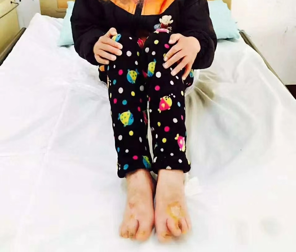 双足溃烂复病例