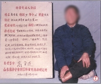 脉管炎康复病例